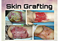 Skin Grafting.pdf